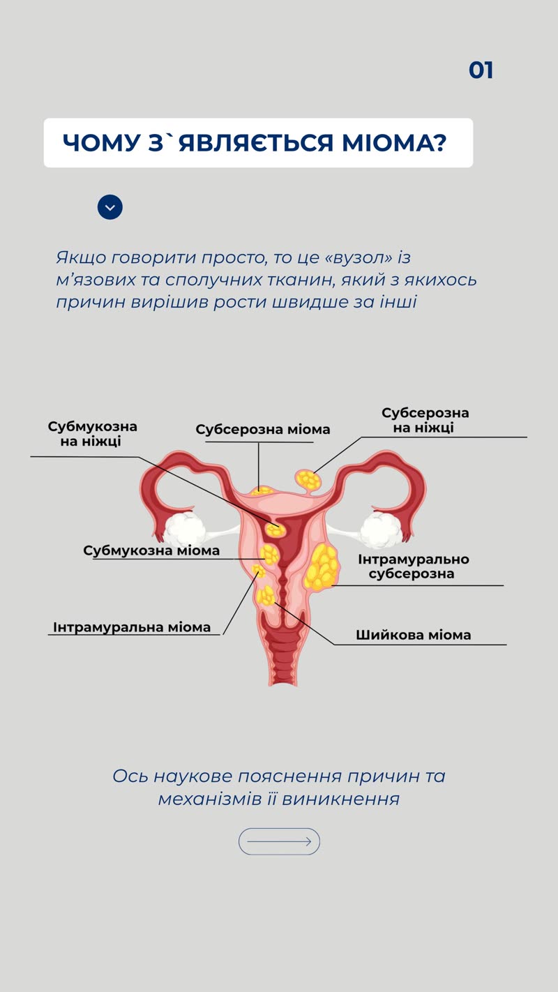 Чому з'являється міома — анатомія і типи вузлів